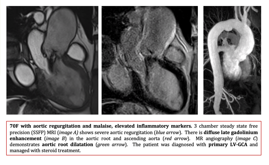70F with aortic regurgitation and malaise
