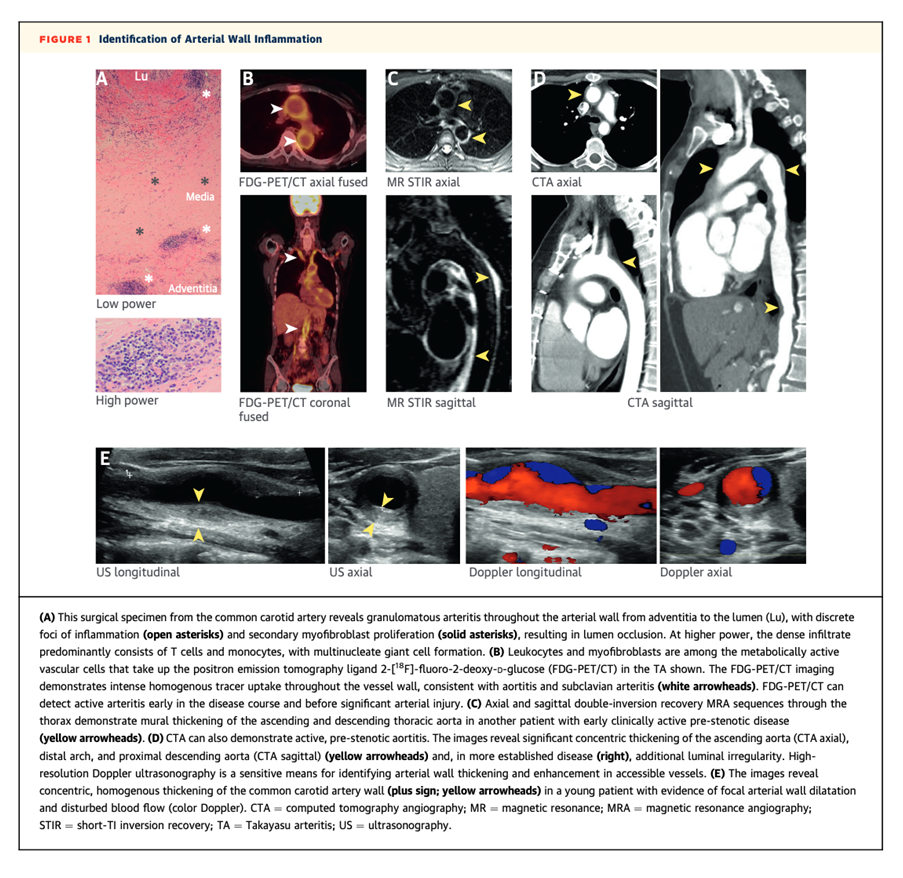 Identification of Arterial Wall Inflammation