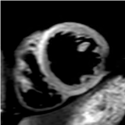 CMR Image of Oedema_Inflammation